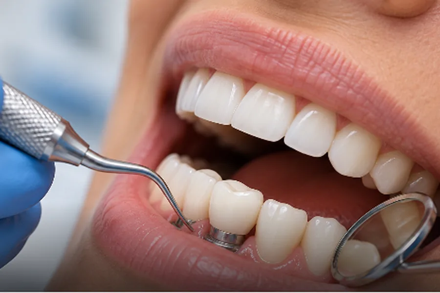 Gloved dentist cleaning around a metal dental implant abutment on a patient's lower back teeth with a scaler, mouth mirror held alongside